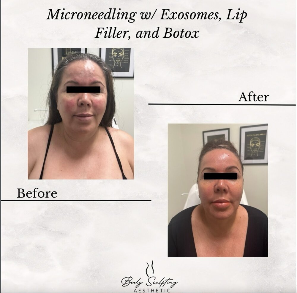 Microneedling with Exosomes before and after